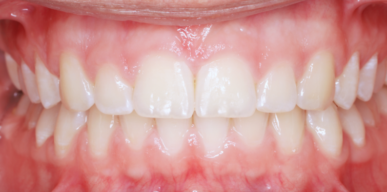 Stan po leczeniu - przypadek 1