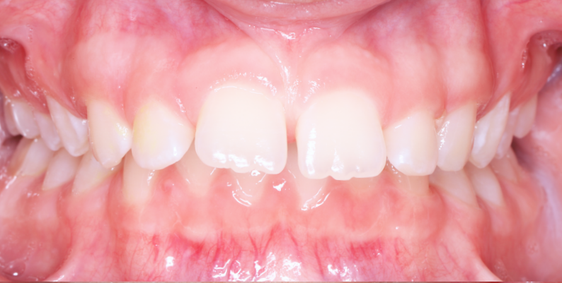 Stan przed leczeniem - przypadek 1