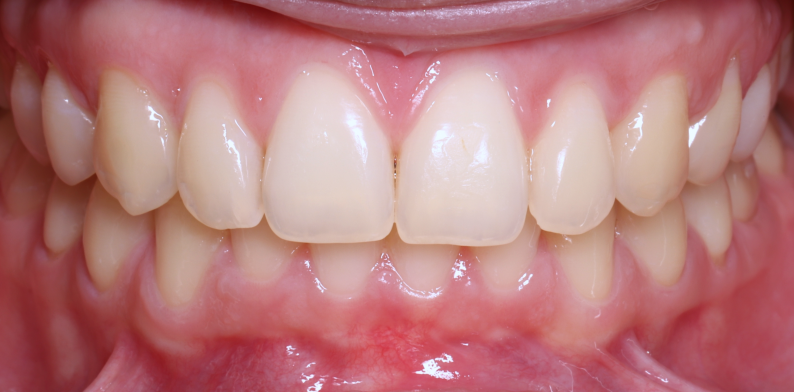 Stan po leczeniu - przypadek 2