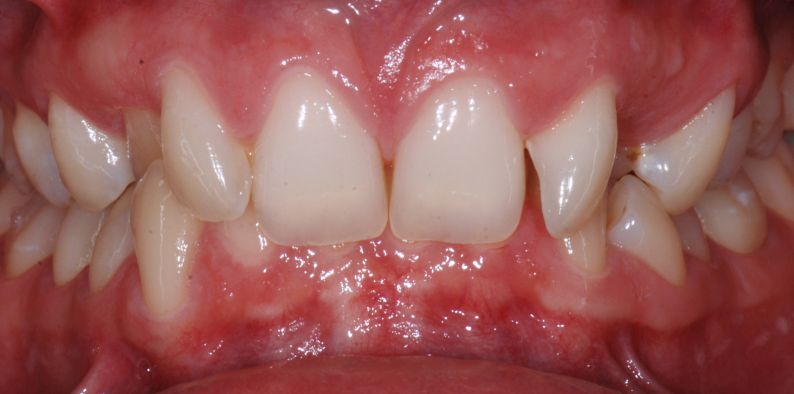 Stan przed leczeniem - przypadek 2