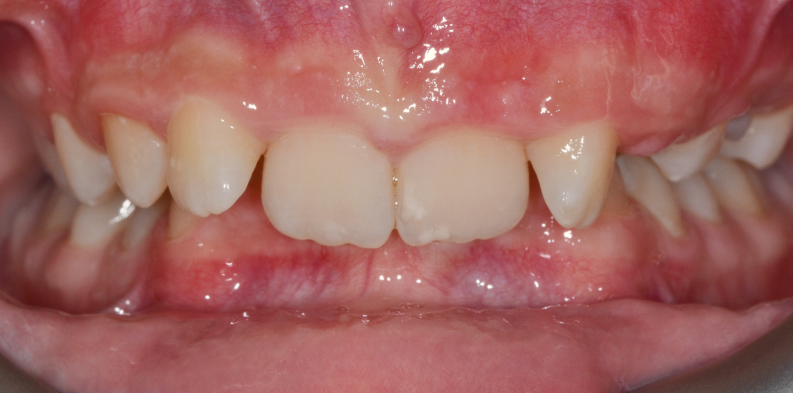 Stan przed leczeniem - przypadek 3