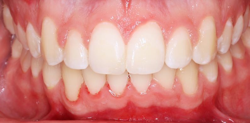 Stan po leczeniu - przypadek 4