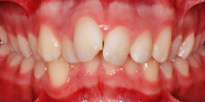 Stan przed leczeniem - przypadek 4