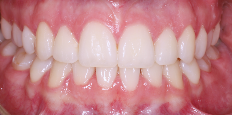 Stan po leczeniu - przypadek 6